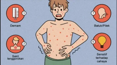 Kemenkes terbitkan SE kewaspadaan usai nakes meninggal gegara campak [titlebase] – Apa yang Perlu Anda Ketahui