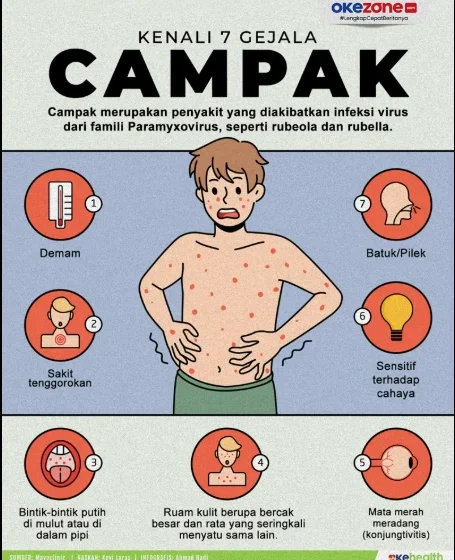 Kemenkes terbitkan SE kewaspadaan usai nakes meninggal gegara campak [titlebase] – Apa yang Perlu Anda Ketahui